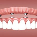 Why Should You Consider Prepless Veneers Dallas?